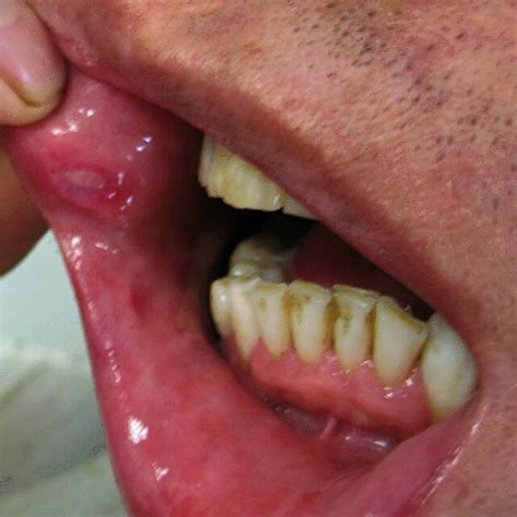 Mouth Ulcers: Comprehensive Guide to Causes, Symptoms, Treatment ...