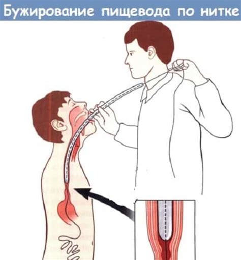Бужирование пищевода: показания и особенности проведения