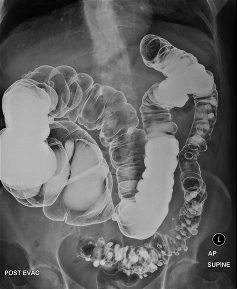 Diverticulosis and Diverticulitis - Maher A. Abbas, MD | Dubai/UAE