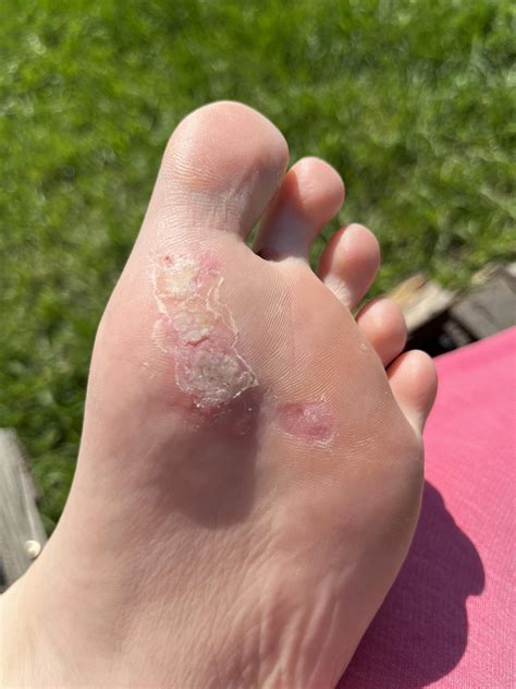 Little over a month in with treatment on mosaic warts : r/Warts