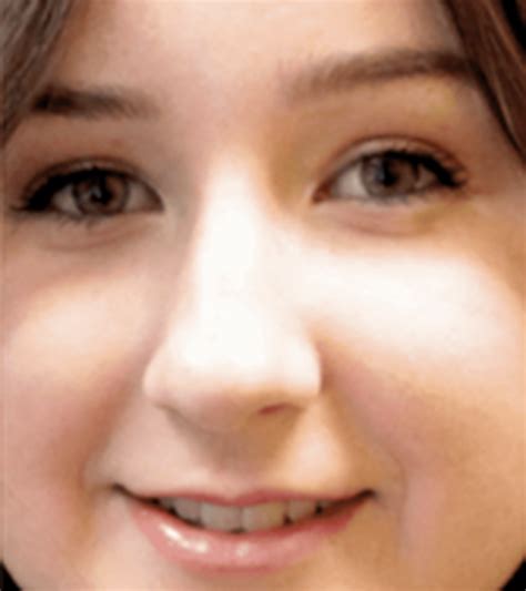 BBL Treatments | Laser Clinics Australia