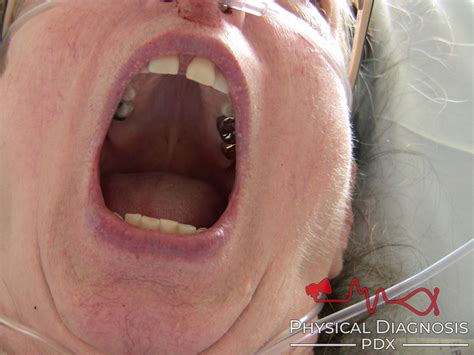 High Arched Palate - Physical Diagnosis PDX