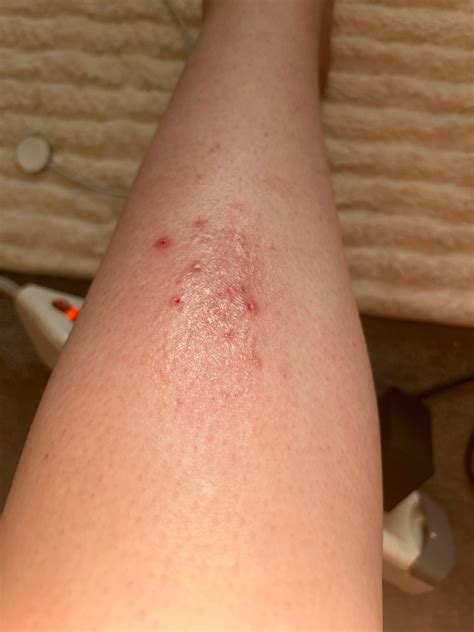 Leg rash what could it be : r/DermatologyQuestions