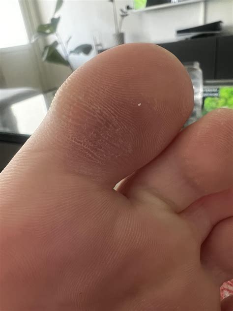 Warts coming back? : r/Warts