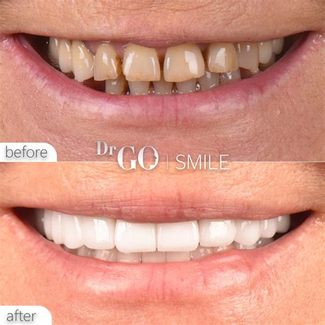 Poor Dental Hygiene and Overall Health: Interesting Facts - DRGO Smile