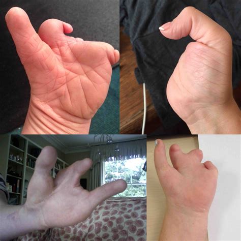 Limb Difference Aid - The Active Hands Company