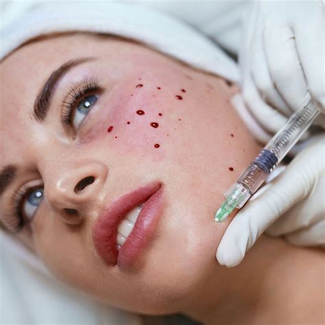 Vampire Facial/ PRP Vampire Facelift - The Beauty House