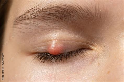 poster chalazion   eyelid  girl macro wall art ukposters
