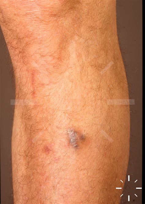 DermaCompass - Dermatofibrom, Histiozytom, DF