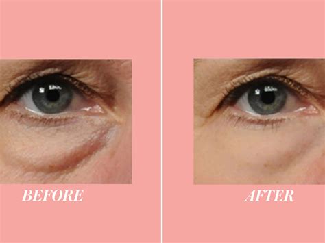 how to conceal bags under eyes 5