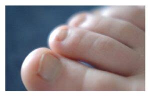 Treatment Options for Curved Toenails | Care for Yoo