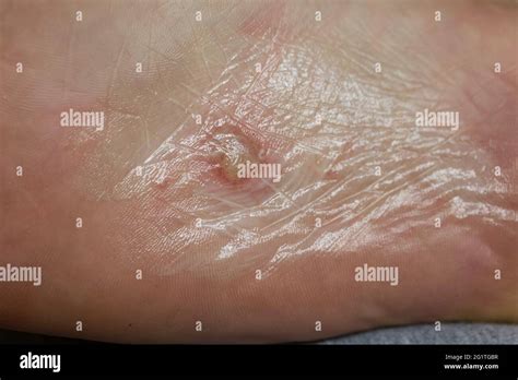 Dyshidrotic eczema on the foot. Blister dermatitis. Treated with ...