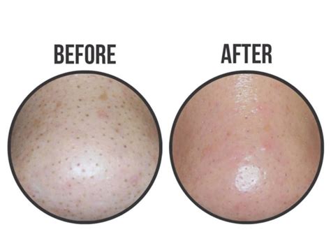 Mặt Nạ Lột Mụn Đầu Đen Ciracle Goodbye Blackhead Mask 5mlMặt Nạ Lột Mụn ...