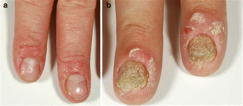 a Nail psoriasis with typical pitting. b Nail psoriasis | Download ...