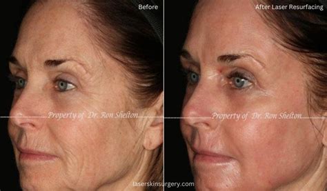 Laser skin resurfacing before and after photo gallery New York City