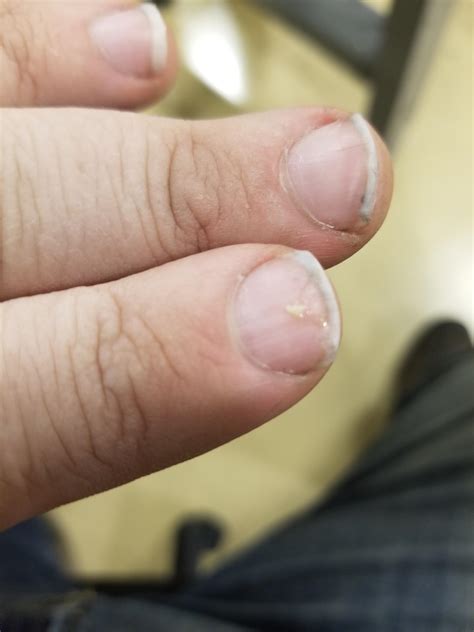 This guide explains why is there a bump on my earlobe 6