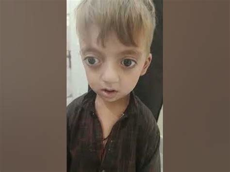 Crouzon syndrome - YouTube