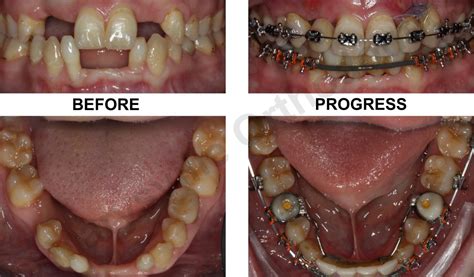 Can you get braces with missing teeth? - Dental Clinic in Kampala