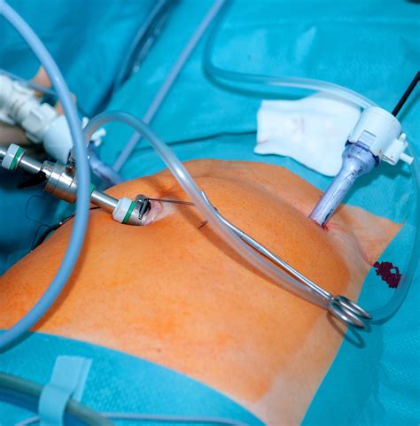 Endoscopy Hiatal Hernia at Nedra Harris blog