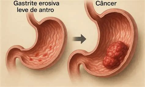 Gastrite Enantematosa Leve De Antro - Gastrite erosiva leve de antro pode virar câncer? - Blog Dr. Thiago ...