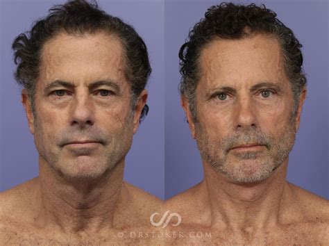 Facelift for Men Before and After Photo Gallery | Marina del Rey, CA ...