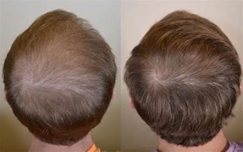 Finasteride Guide: Uses, Results & Side Effects | Wimpole Clinic