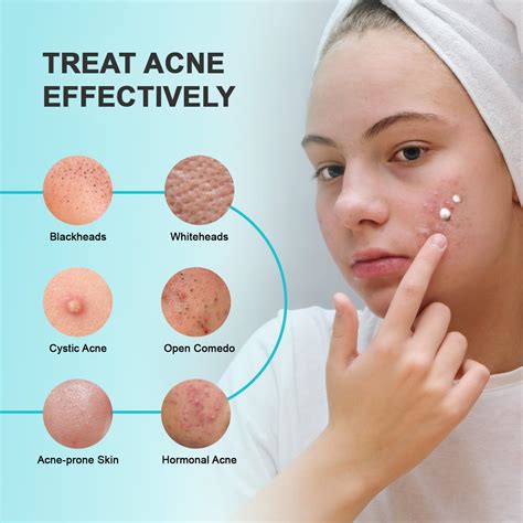 Acne Pimple Spot Treatment Cream: Cystic Hormonal Philippines | Ubuy