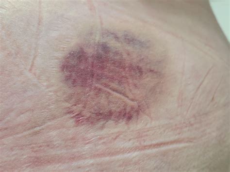 Bruising from injection? : r/Zepbound