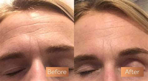 Before and after pictures – Maxine Laceby