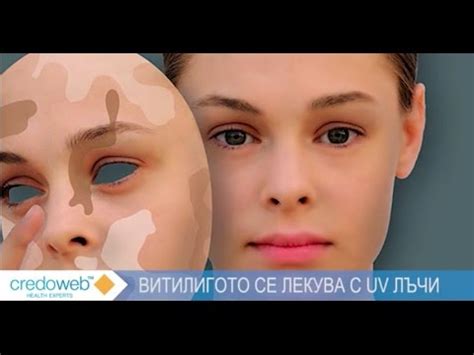 Д-р Гриша Матеев: Витилигото се лекува с UV лъчи - YouTube