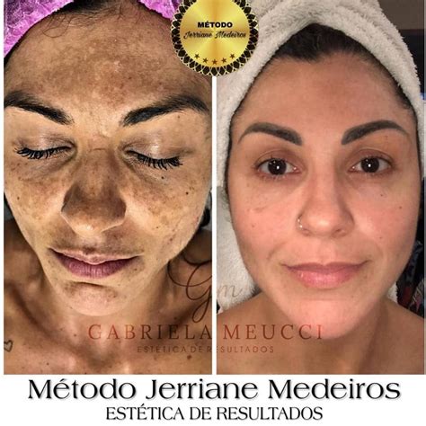 Qual Acido Para Melasma - ácido Tranexâmico Injetável Para Melasma Antes E Depois - RETOEDU