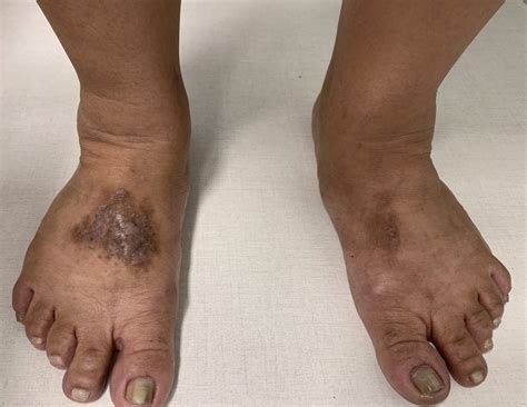 Mancha Escura No Corpo