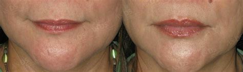 Can You Put Hyaluronic Acid On Lips With Filler | Lipstutorial.org