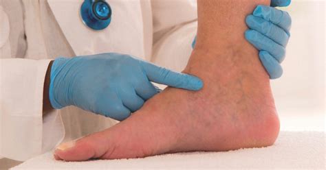 What is Edema? - Ashchi Heart & Vascular Center