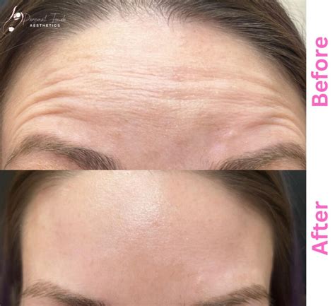 Botox Before And After Picture | Tucson, AZ