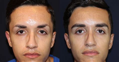 Eyebrow Transplants Are The Hottest and Latest Beauty Treatments! #