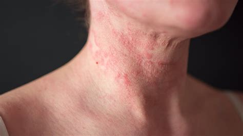 Eczema Circular Rash