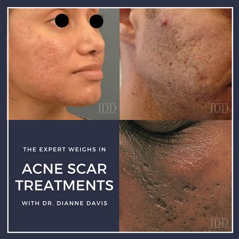 What Treatments Help Acne Scars at John Morris blog
