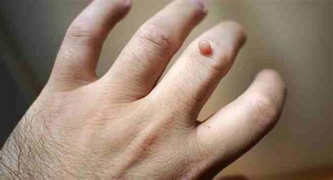 Best method of treating warts with apple cider vinegar | TheHealthSite.com