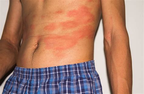 Red Rash: Symptoms, Causes and Treatment