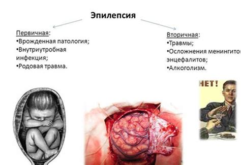 Эпилепсия: причины возникновения, симптомы, лечение, первая помощь при ...