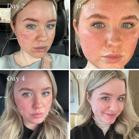 Chemical Peel: Hướng Dẫn Toàn Diện và Lợi Ích Chăm Sóc Da