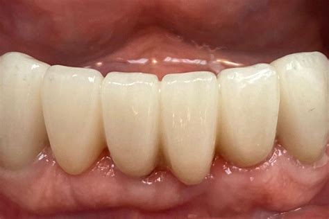 Full Mouth Dental Implants | Plantation, FL | Atlas Smiles™