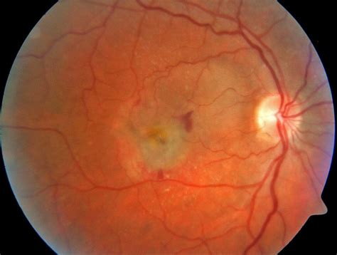 Abnormal fundoscopic appearances | OSCEstop | OSCE Learning