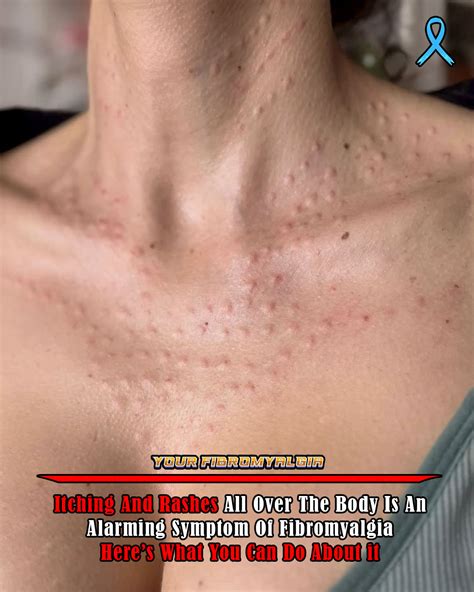 living  fibromyalgia   hard