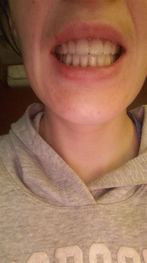 Do these look totally fake? : r/dentures