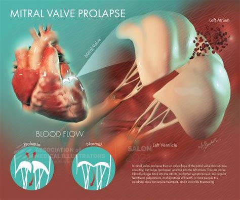 Mitral Valve Prolapse | AMI Meeting 2021