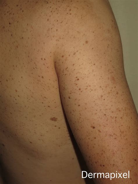 Dermapixel: Lentiginosis segmentaria: un mosaicismo curioso