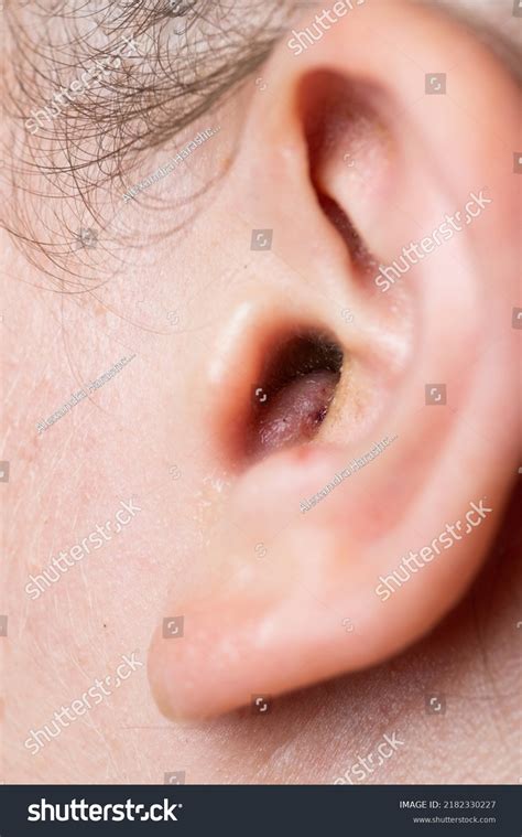 Close Abscess Inflammation On Ear Area Stock Photo 2182330227 | Shutterstock