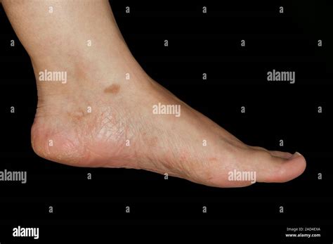 Psoriasis. Close-up of psoriasis affecting the foot of a 35-year-old ...